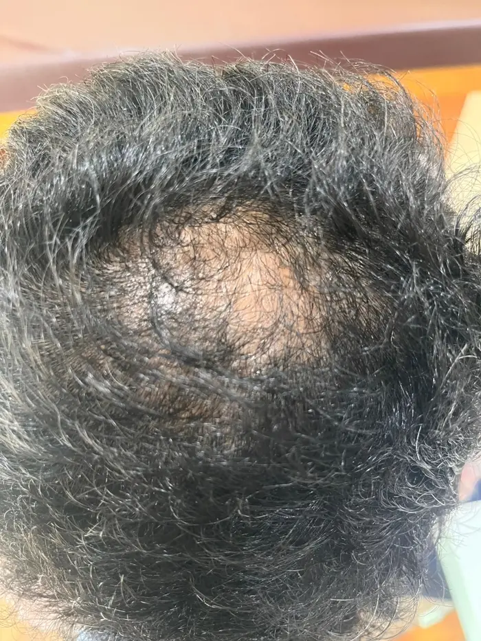 Male Pattern Baldness Before